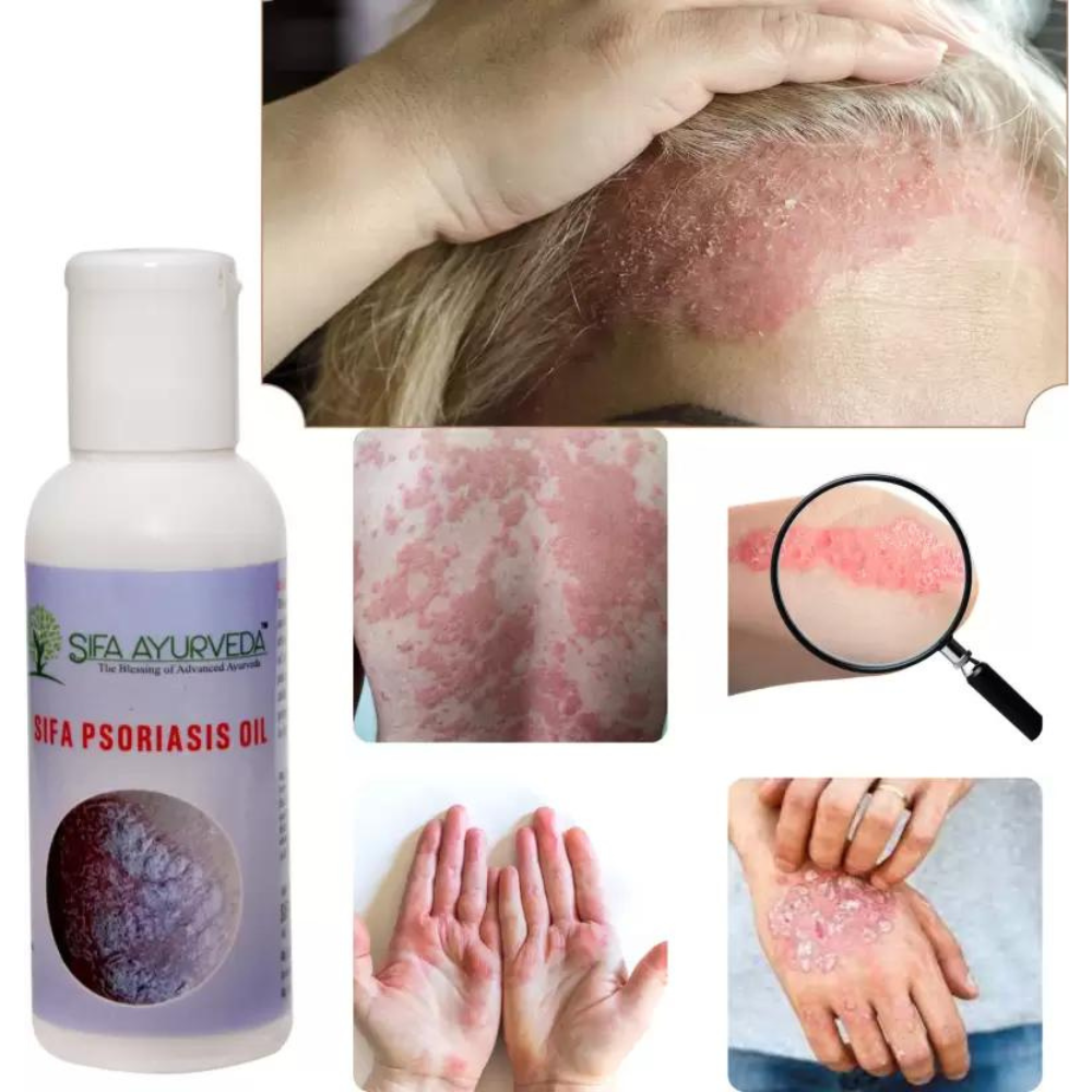 Sifa Ayurveda Psoriasis Oil - 60 ml
