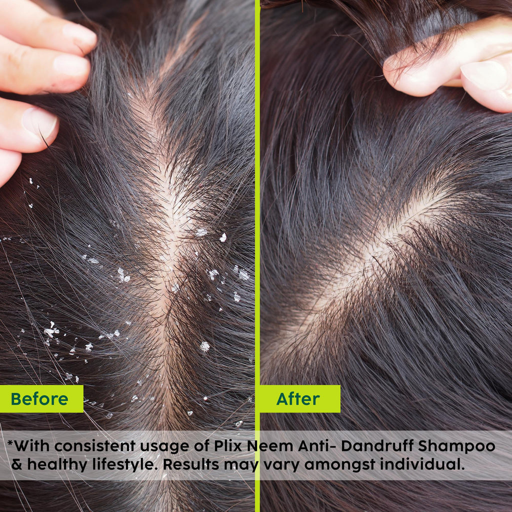 Plix Neem Anti-Dandruff Advanced Shampoo - 200 ml