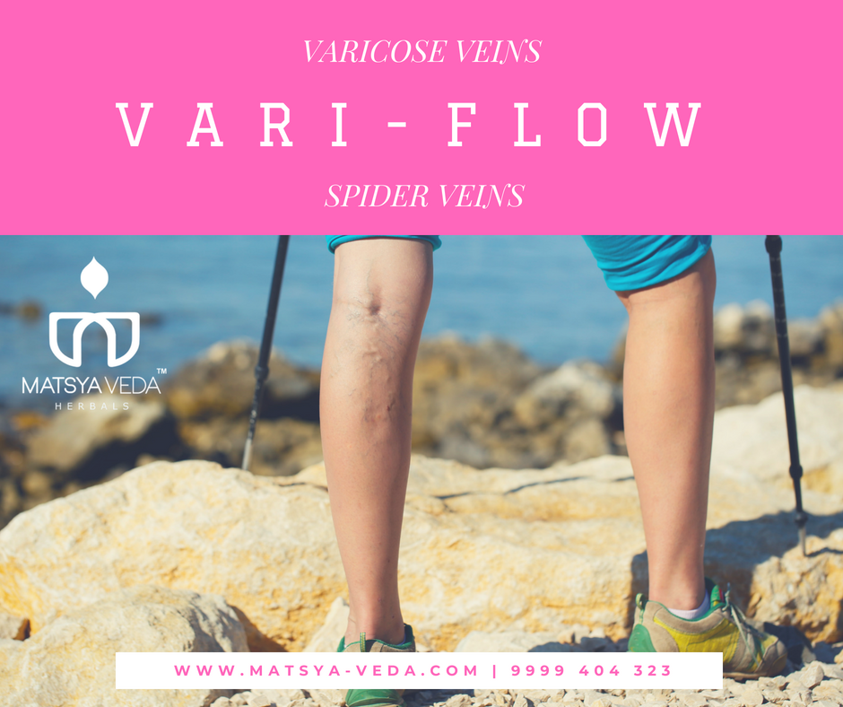 Matsyaveda Vari Flow: Varicose Veins