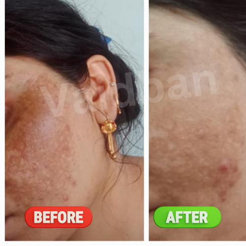 Vaidban Rupanjali AM Oil - 10 ml
