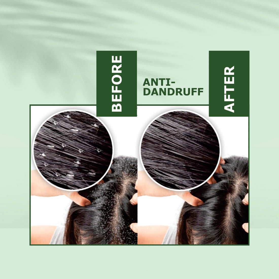Nuerma Science Anti-Dandruff Hair Oil | Dandruff Relief & Scalp Rejuvenation