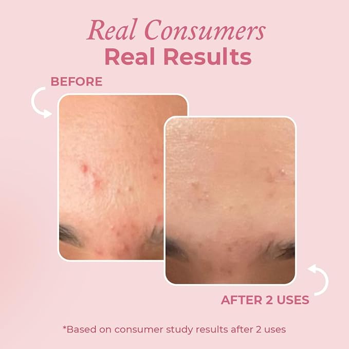 The Pink Foundry Acne Spot Corrector With Salicylic Acid & Sulfur for Active Acne, Blackheads & Whiteheads - 15 Ml
