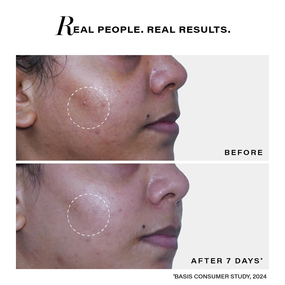 Novology Acne Deep Clearing Cleanser with Thymol+Terpineol| Face Wash for Acne,Whiteheads,Blackheads| Gentle, Non-Drying Formula, Suitable for Sensitive skin| 150g