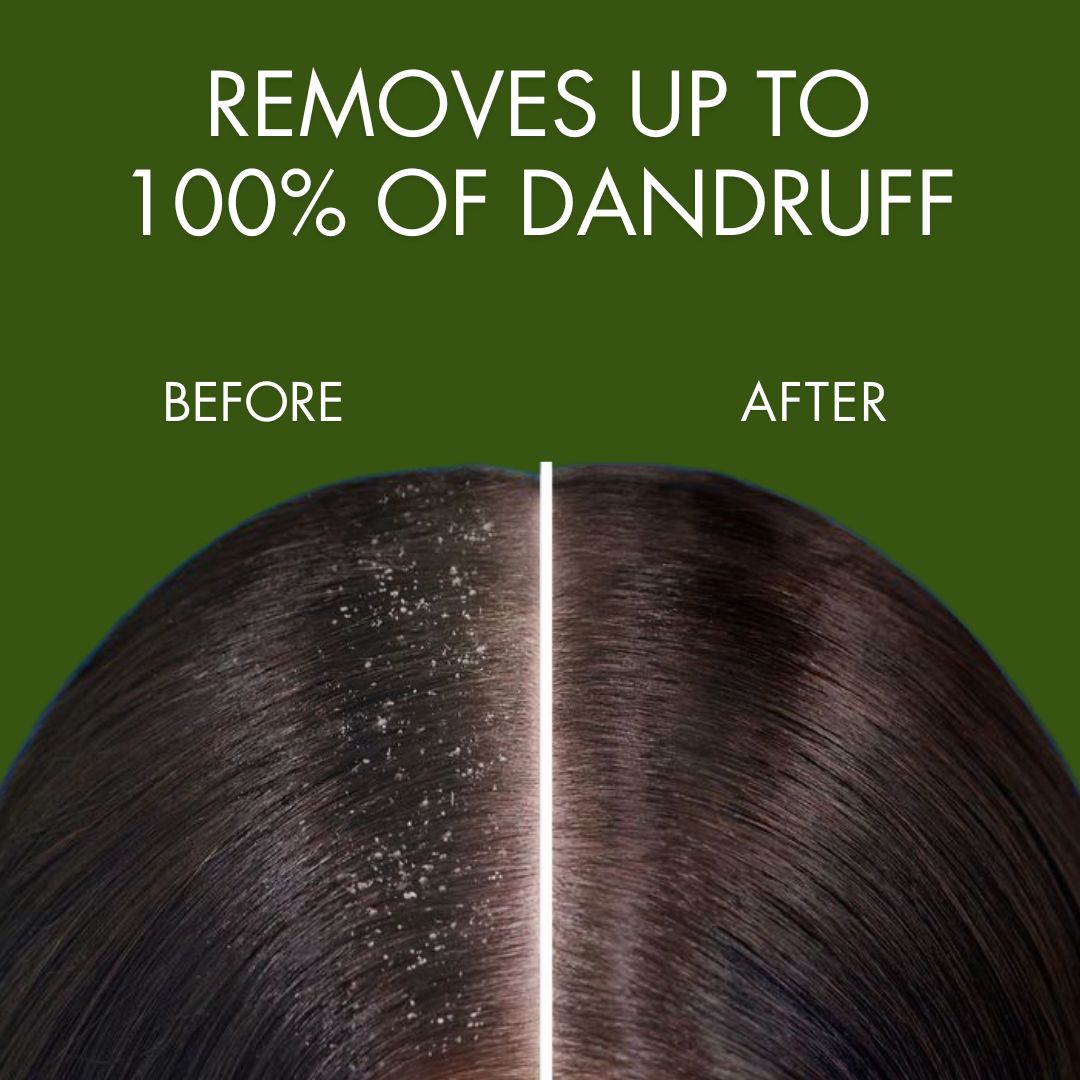 Samisha Anti Dandruff Spray