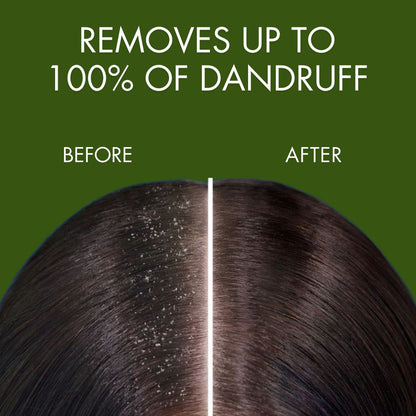 Samisha Anti Dandruff Spray