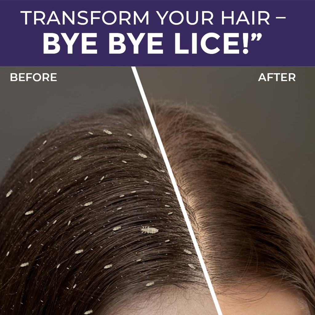 Sanfe Anti Lice and Dandruff Shampoo - 100 ml