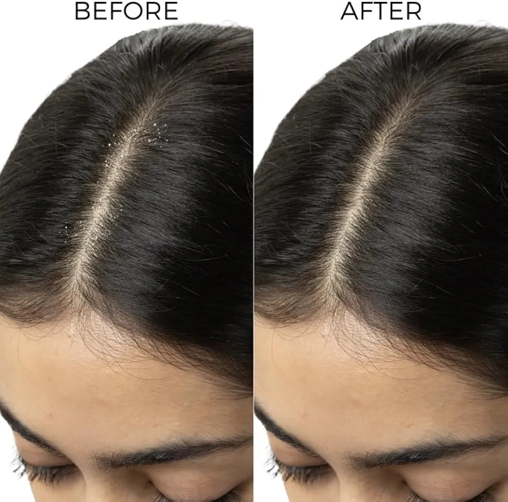 Brillare Lactylate Anti Dandruff Serum for Hair & Scalp - 30 ml