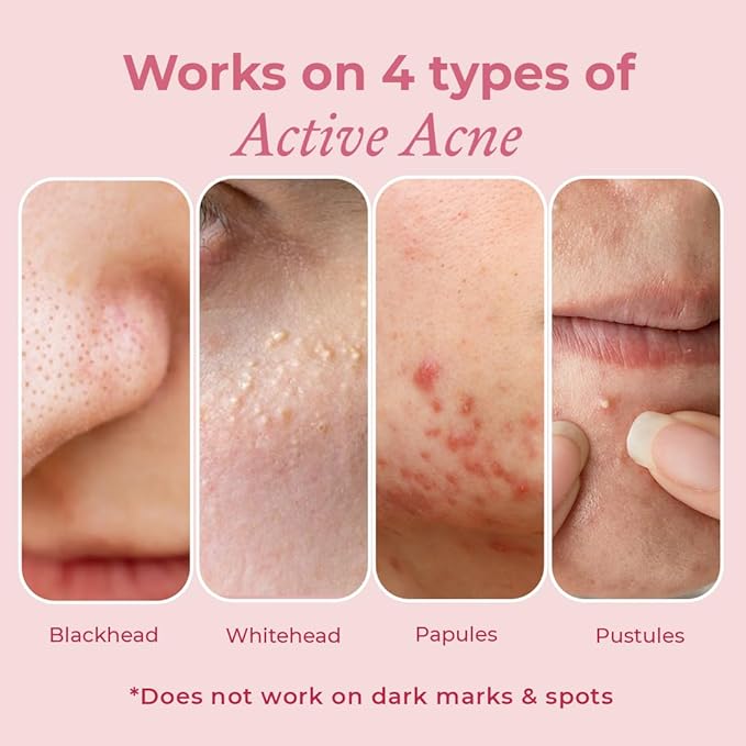 The Pink Foundry Acne Spot Corrector With Salicylic Acid & Sulfur for Active Acne, Blackheads & Whiteheads - 15 Ml