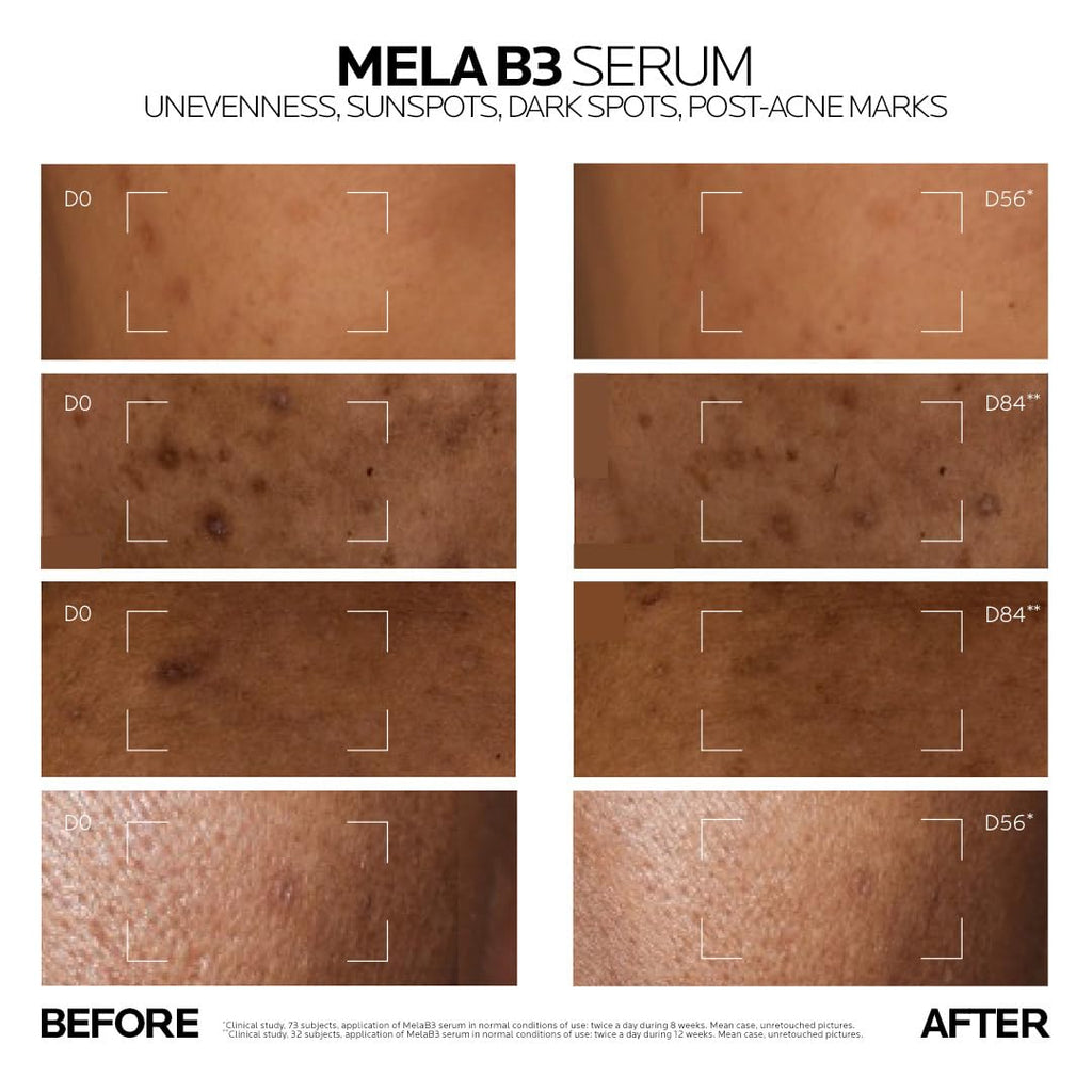 La Roche-Posay Mela B3 Anti-Dark Spot Serum |Corrects Pigmentation, Sun Spots, Age Spots & Post-Acne Marks with Melasyl + 10% Niacinamide for even skin, 30 ml