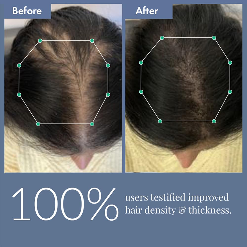 ThriveCo Hair Growth Serum 2.0, 30ml | Advanced Patent Filed Clinically Proven Scalp Treatment for Hair Fall Control & Regrowth | British Medical Publication | Redensyl, Anagain, RegendilÂ®, Rosemary Oil | Lightweight, Non-Sticky Solution | Men & Women