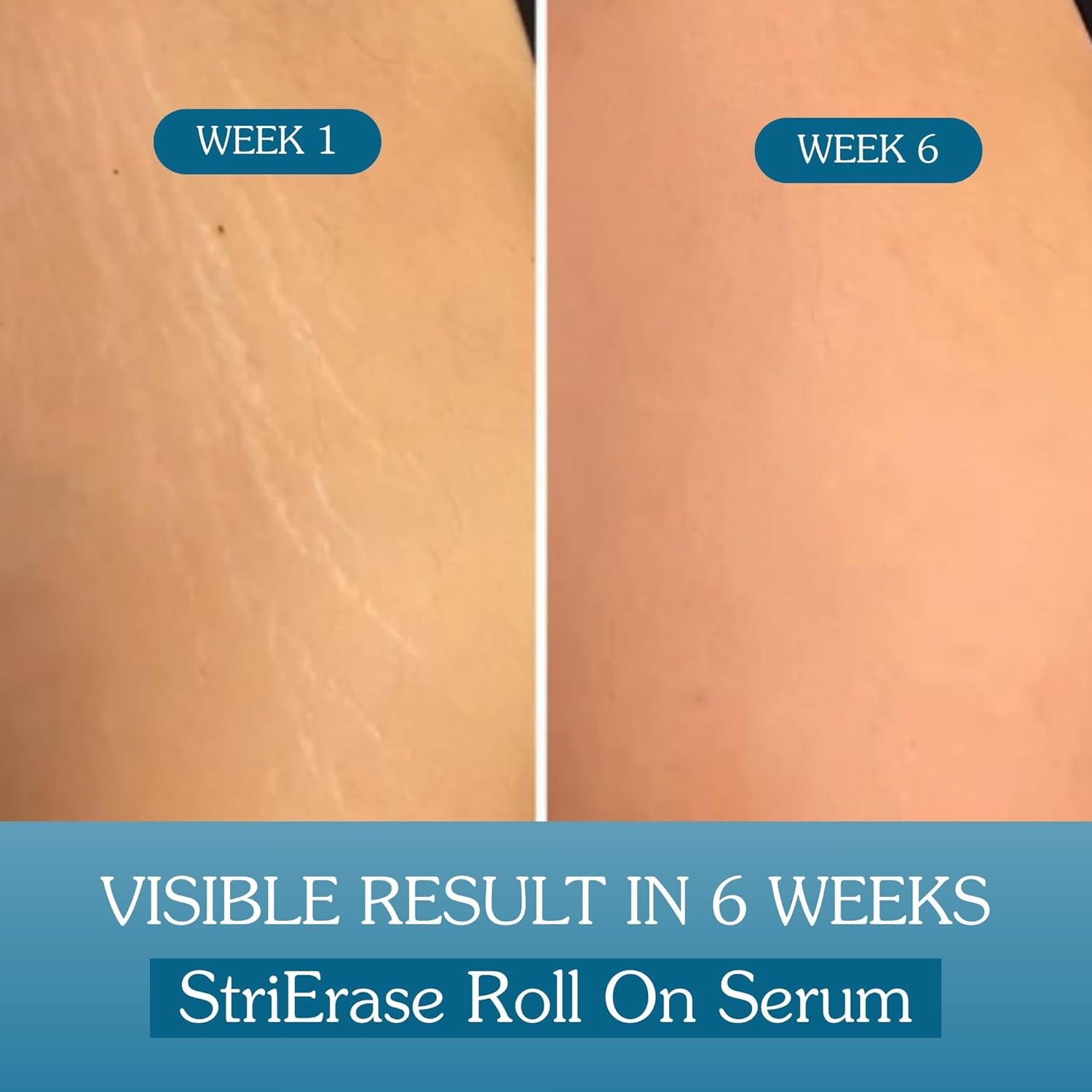 BAKE StriEraseâ„¢ Stretch Marks Removal Roll On Serum | For Pregnancy Use | 0.5% Encapsulated Bakuchiol, 2% Centella Asiatica | Fades Stretch Marks & Scars, Firms Skin & Improves Uneven Skin | Fragrance Free, SLS Free â€“ 50ml
