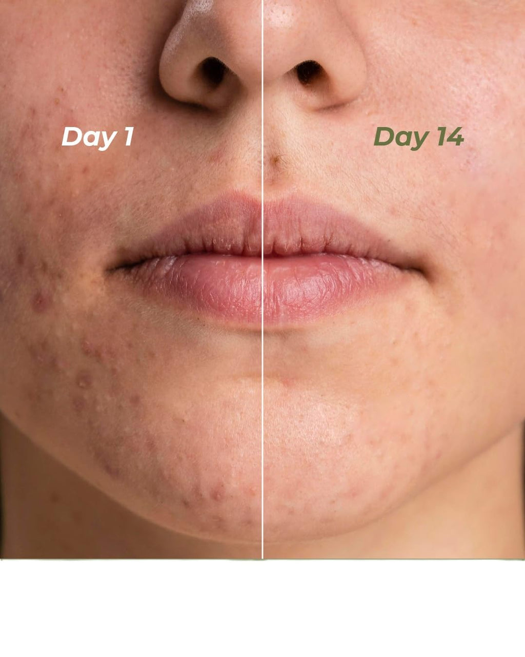 Indus Valley Calming Acne Gel with Seaweed Extract & Tea Tree Oil for Pimples, Soothes, Clarifies, and Refreshes Skin Naturally – 30ml