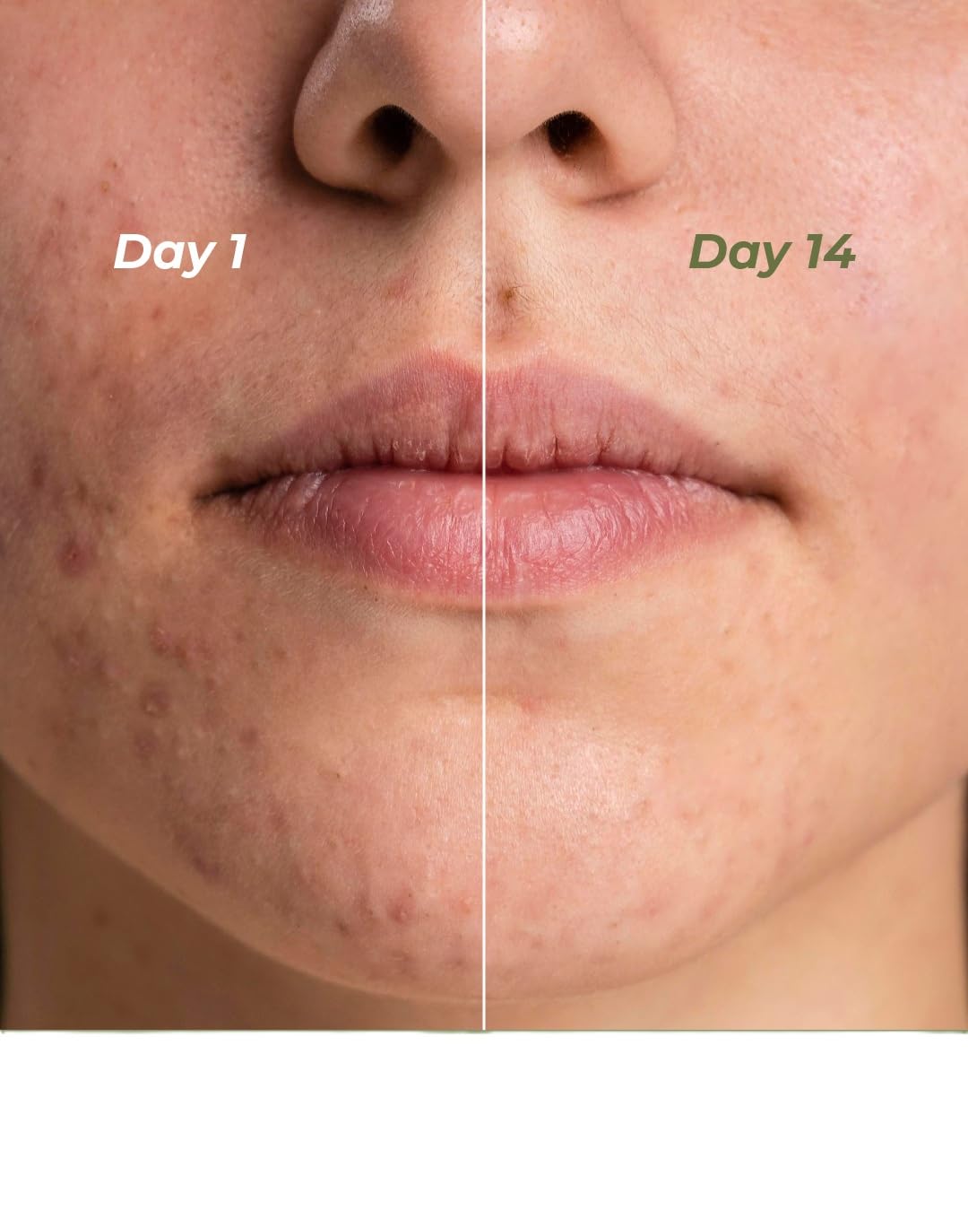Indus Valley Calming Acne Gel with Seaweed Extract & Tea Tree Oil for Pimples, Soothes, Clarifies, and Refreshes Skin Naturally – 30ml