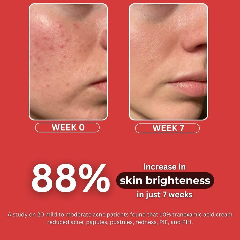 BLUSHLIN 10% Tranexamic Acid Cream with 2% Kojic Acid + 5% Vitamin C + 1% Arbutin | Pigmentation Removal Face Cream | Helps Even Skin Tone, Reduce Dark Spots, Blemishes and Scars - 10gm