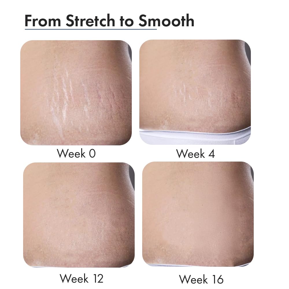 ThriveCo Stretch Marks Expert Serum Cream | Clinically Proven Treatment for New red & Old white Stretch Marks & Scars Removal | Infused with Collarev®, Striover™, Rosehip Oil | Women & Men (Stretch Marks 30ML)