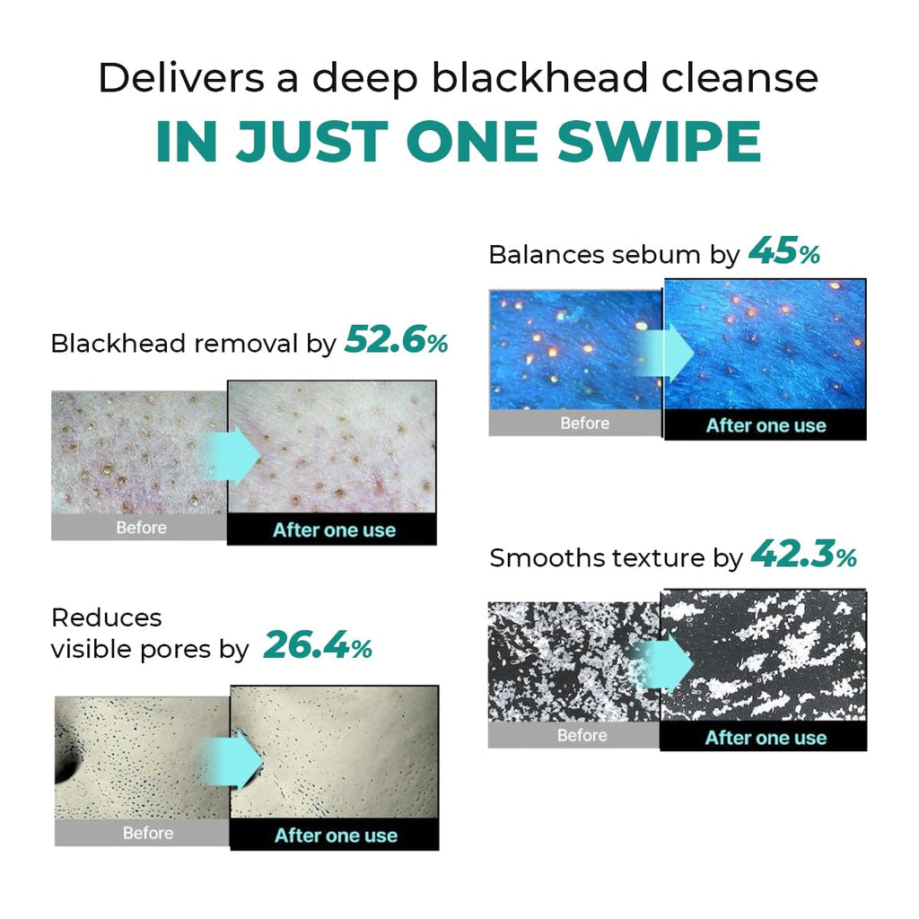 Conscious Chemist® Blackhead Melting Water | 130ml | Gentle Pore treatment with Succinic, Glycolic Acid & CICA Exosome | Unclogs Pores, Dissolves Blackheads & Smoothens Skin | Toner For Men & Women