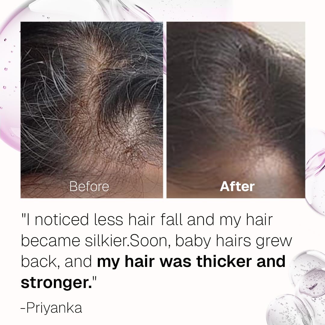 Bontress PRO+ Scalp Serum | Powered by Pro Active Peptides – 5% Capixyl, 3% Redensyl, 3% Anagain, 3% Procapil | Dermat recommended Hair Growth Serum | 94% Users Reported Hair Growth in 28 Days | 30ml