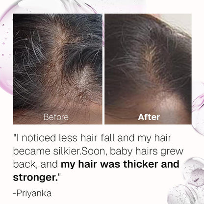 Bontress PRO+ Scalp Serum | Powered by Pro Active Peptides – 5% Capixyl, 3% Redensyl, 3% Anagain, 3% Procapil | Dermat recommended Hair Growth Serum | 94% Users Reported Hair Growth in 28 Days | 30ml