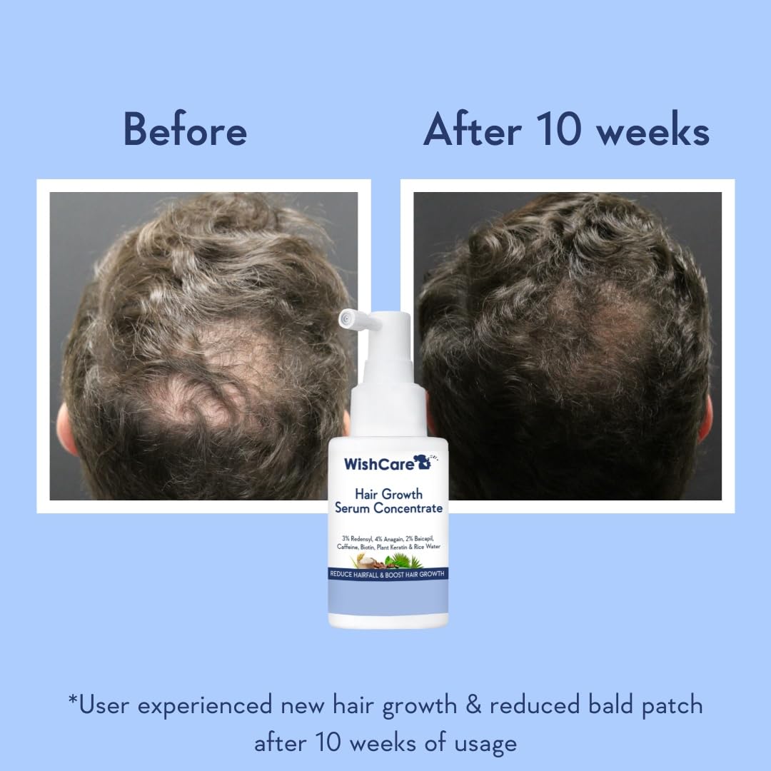 WishCare Hair Growth Serum Concentrate - 3% Redensyl, 4% Anagain, 2% Baicapil, Caffeine, Biotin, Plant Keratin & Rice Water - Hair Growth Serum For Men & Women, 30ml