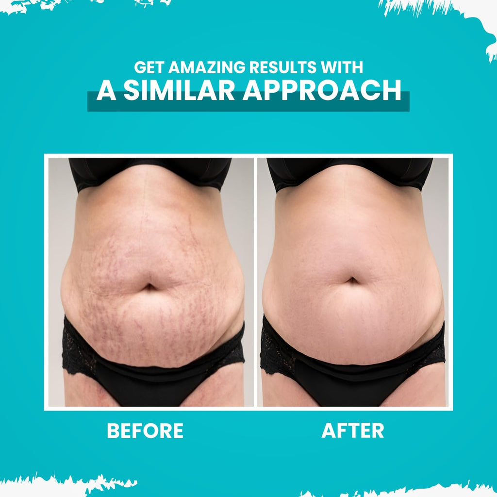 MildCares Stretch Marks Removal Cream (50gm) | For Prevents Stretch Marks, Nourish & Hydrating Skin | With Shea Butter, Saffron, Kokum Butters | All Skin Types | Stretch Marks Cream For Women