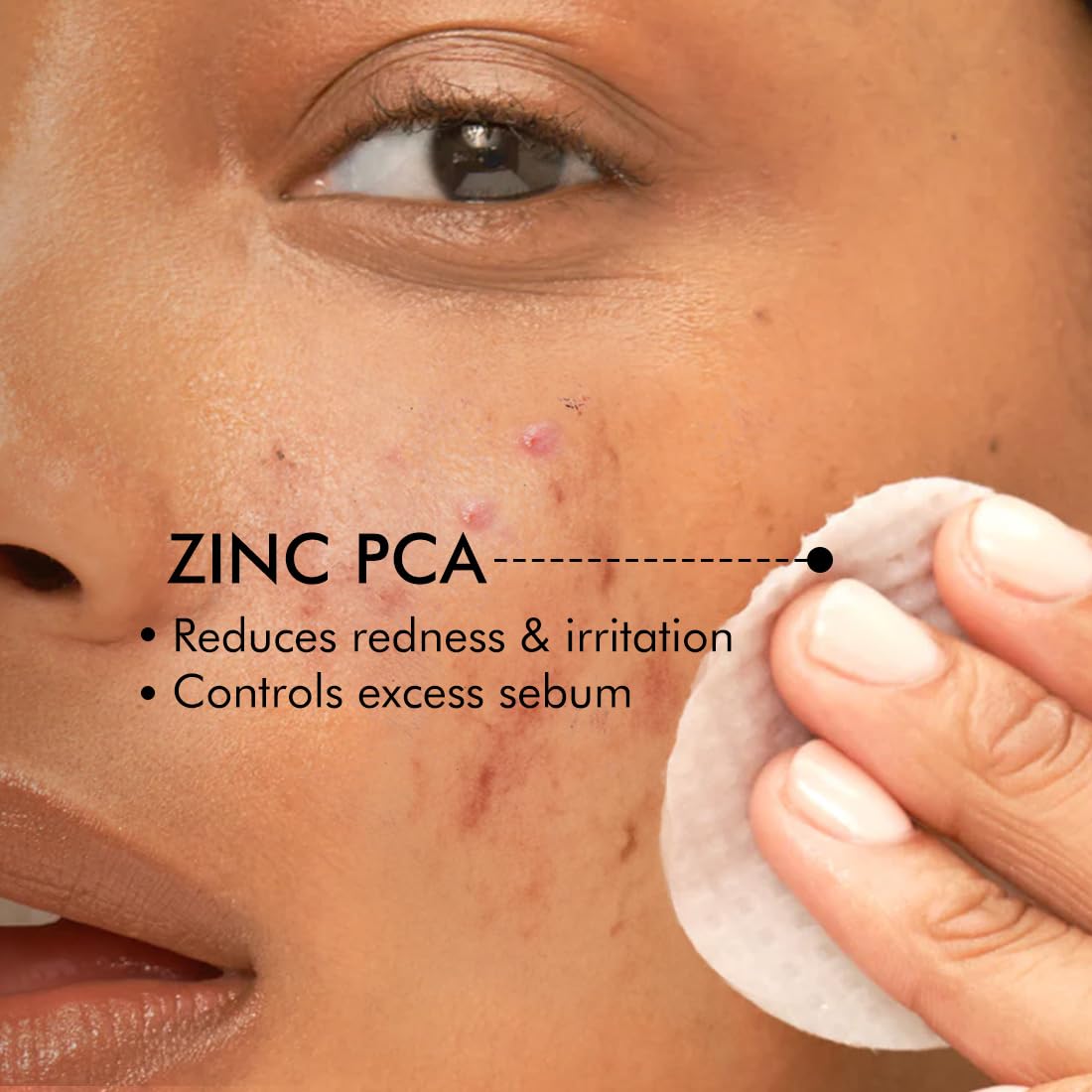 mCaffeine 2% Salicylic Acid Zinc PCA & Matcha Tea Clear Skin Acne Pads | Anti Acne Exfoliating Serum Toner Pads for Acne-Prone Skin | For both Women and Men - 40 N (x1)