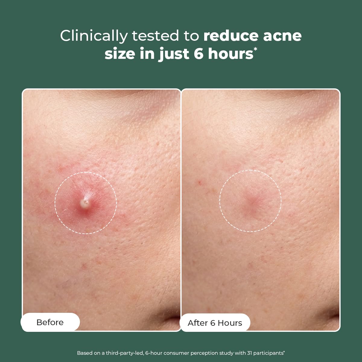 Conscious ChemistÂ® Rapid Relief Acne Spot Corrector Gel | 15g | Triple-Action Treatment with 2% Salicylic Acid & Azelaic Acid | Clears Pimples, Reduces Redness & Fades Dark Spots | For Men & Women