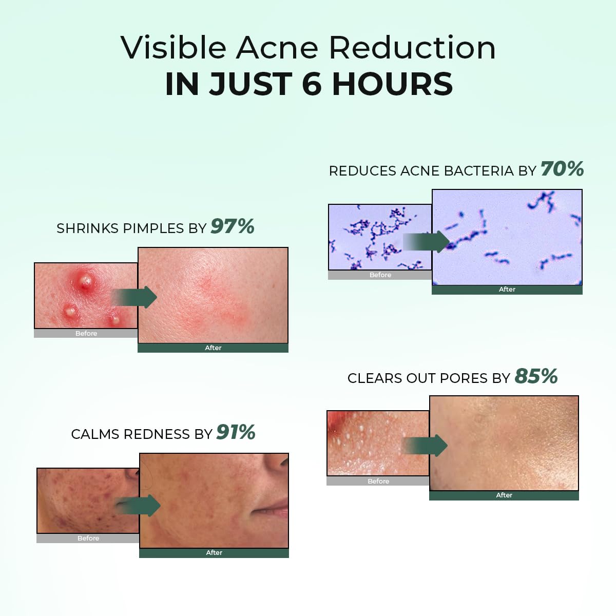 Conscious ChemistÂ® Rapid Relief Acne Spot Corrector Gel | 15g | Triple-Action Treatment with 2% Salicylic Acid & Azelaic Acid | Clears Pimples, Reduces Redness & Fades Dark Spots | For Men & Women