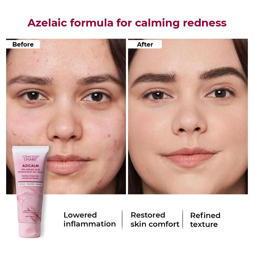 Conscious ChemistÂ® 10% Azelaic Acid Cream | 50g | Face Cream for Men & Women, Moisturizer for Acne Prone Skin, Redness Relief, Soothe Irritation & Inflammation, All Skin Types - Azicalm