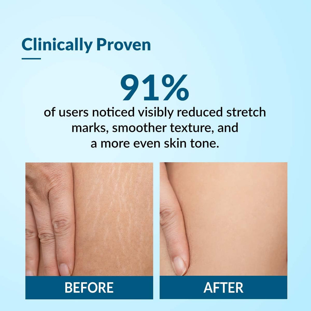 Fixderma Strallium Stretch Mark Cream, Removes Pregnancy stretch marks, Scar removal and Moisturizing Cream, Stretch mark remover for Stomach, thighs & all body parts- 75g