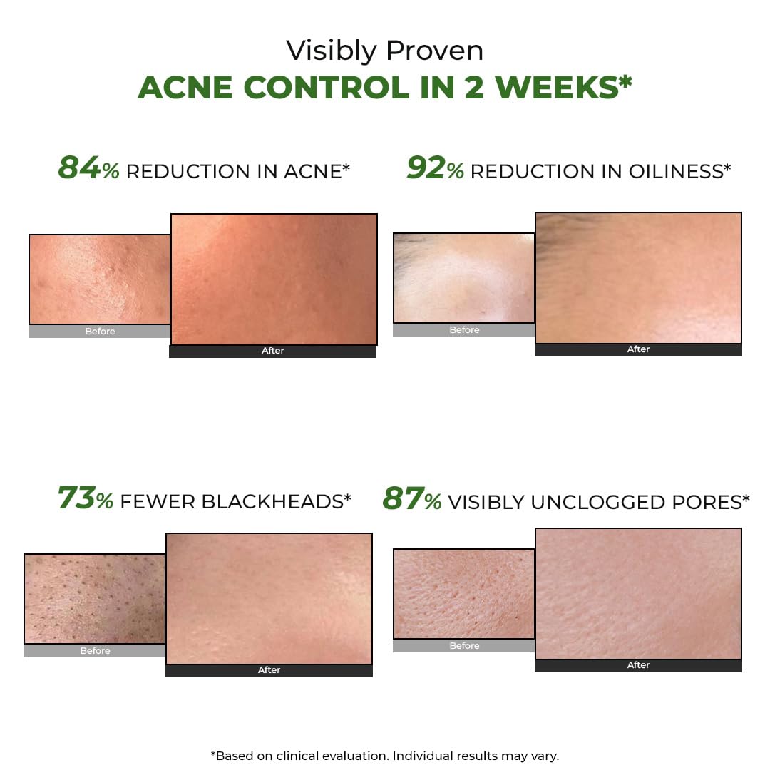 Conscious Chemist® 2% Salicylic Acid Cream | 50g | Acne Spot Corrector | Moisturizer for Oily Acne Prone Skin, Face Cream for Men & Women, Overnight Acne & Oil Control, Itchiness & Redness, Non greasy Gel Cream - Flashfix