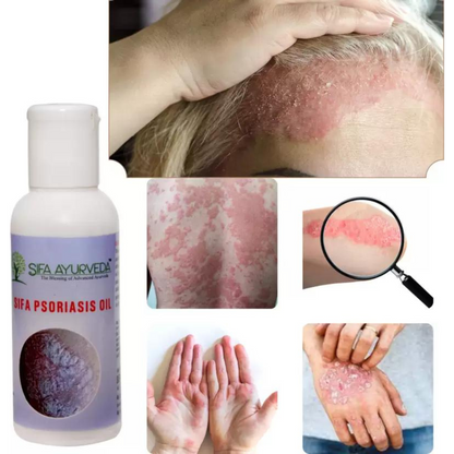 Sifa Ayurveda Psoriasis Oil - 60 ml