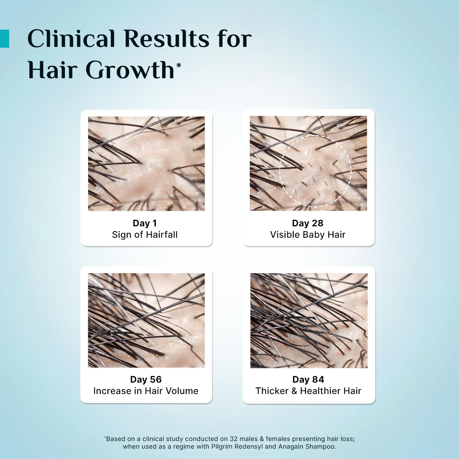 Pilgrim Redensyl 3% + Anagain 4% + 5% Capilia Stem Advanced Hair Growth Serum (30ml) for Scalp with Korean Black Rice & Rosemary | Control Hair Fall, Stimulate Hair Regrowth, Increase Hair Density