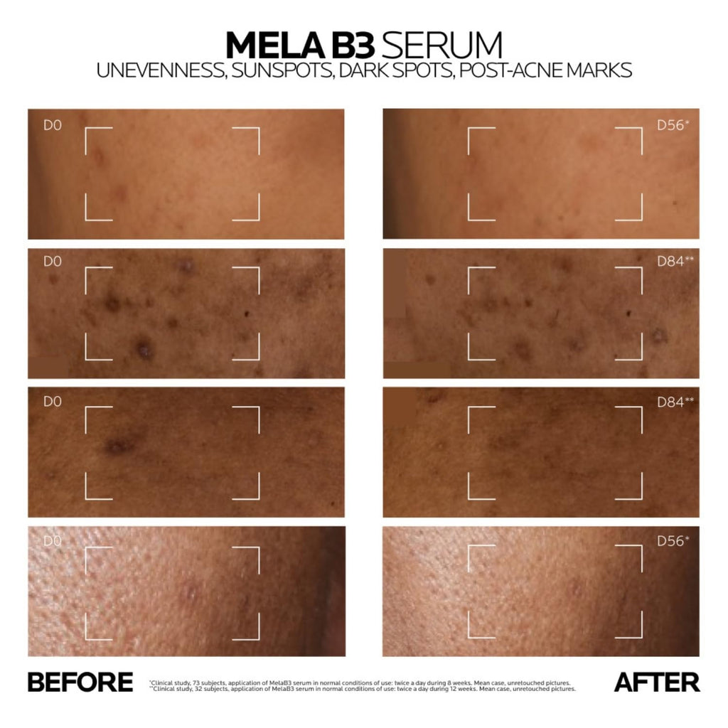 La Roche-Posay Mela B3 Anti-Dark Spot Serum |Corrects Pigmentation, Sun Spots, Age Spots & Post-Acne Marks with Melasyl + 10% Niacinamide for even skin, 10 ml
