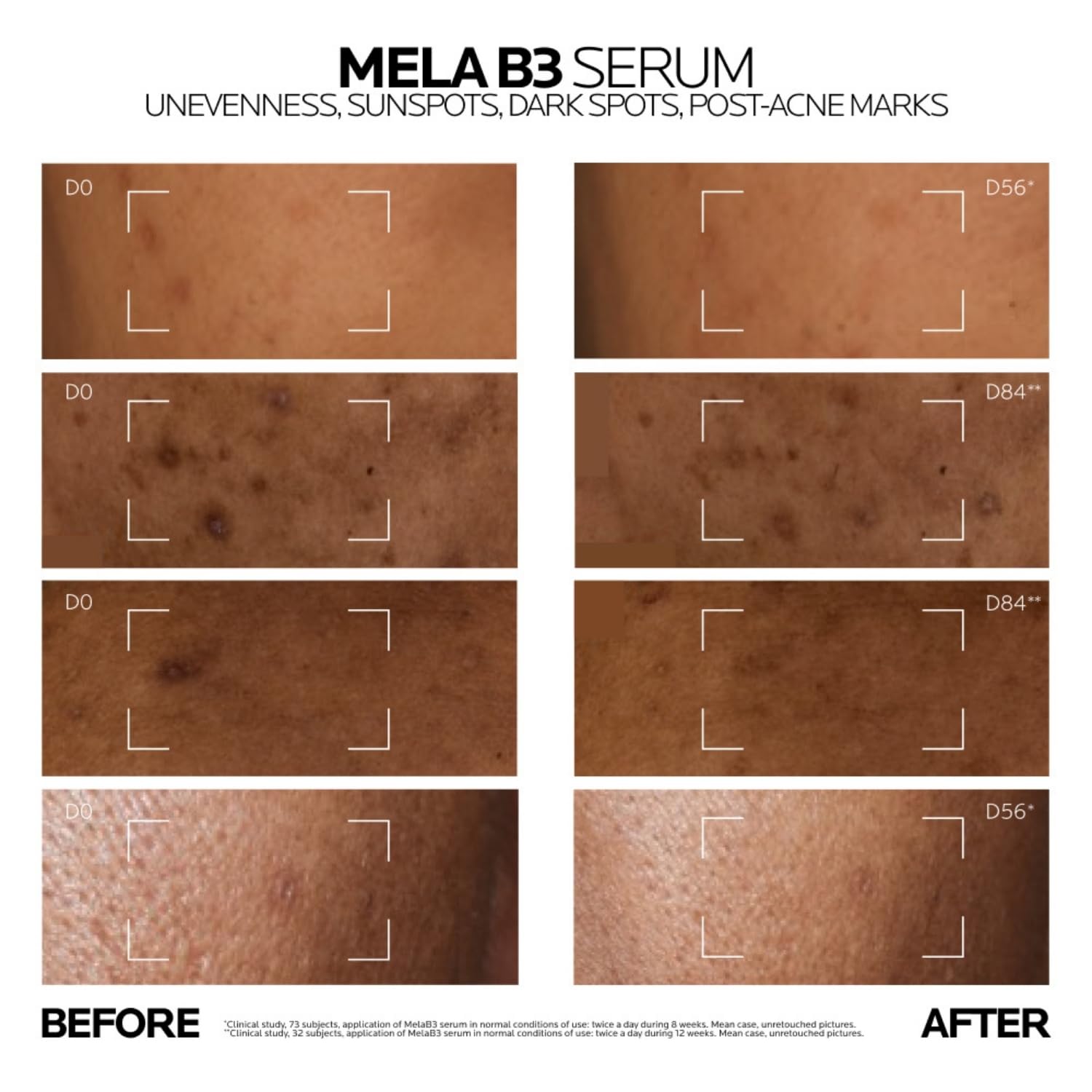 La Roche-Posay Mela B3 Anti-Dark Spot Serum |Corrects Pigmentation, Sun Spots, Age Spots & Post-Acne Marks with Melasyl + 10% Niacinamide for even skin, 10 ml