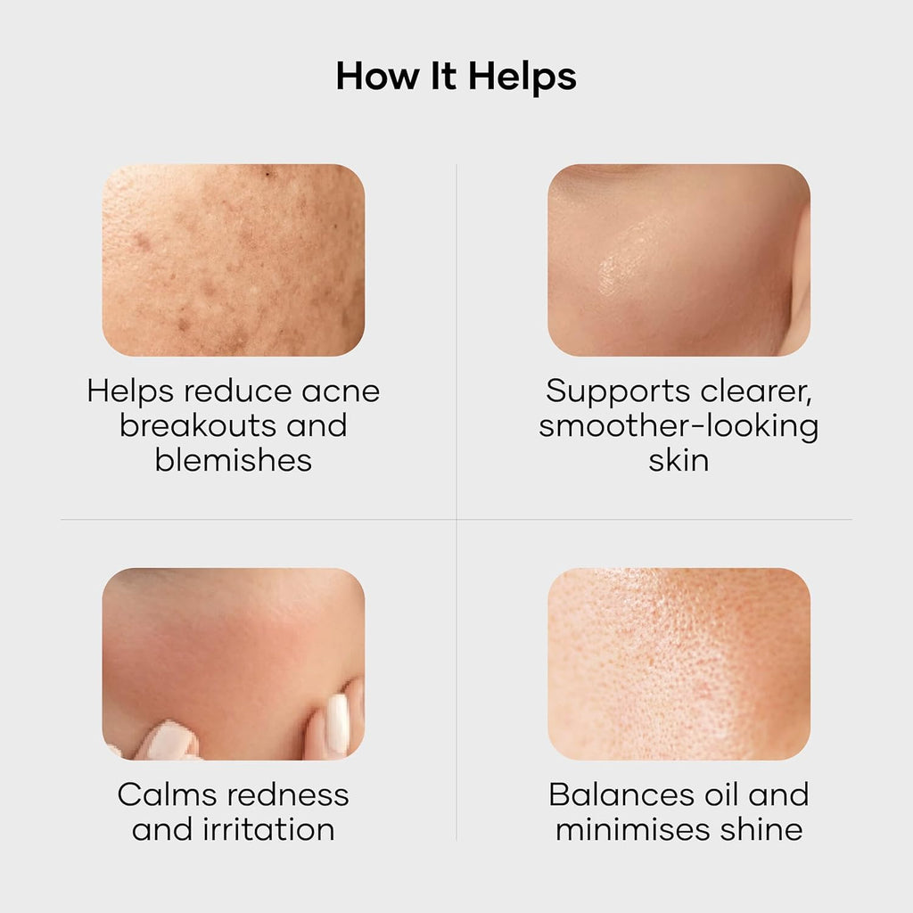 Cureskin Acne Control Gel | Acne Gel Helps Clear Blemishes Without Over Drying | Topical Pimple Cream Visibly Reduces Acne in One Day, 10 g (Pack of 1)