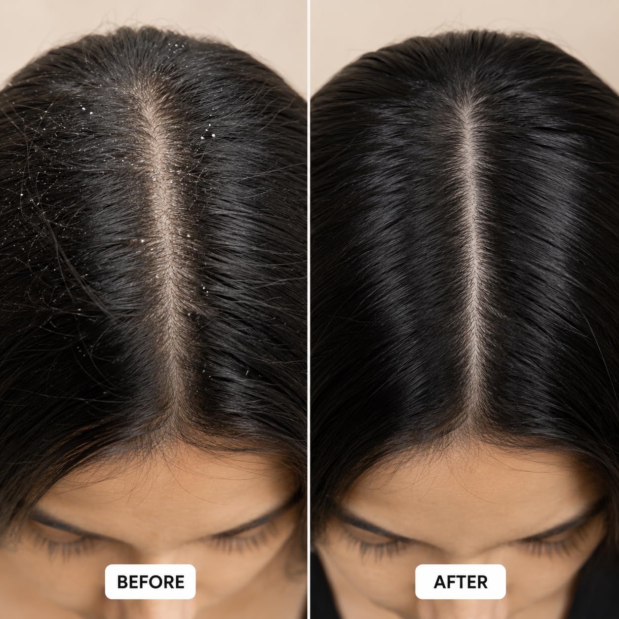 Smishom Anti-Dandruff Shampoo | Dandruff Reduction After First Wash | ZPTO-Free | pH balance | 2% Salicylic Acid & Hydrolyzed Silk Protein | Reduces Dandruff, Itchy Scalp | For All Hair Types | Light Lavender -100 ml