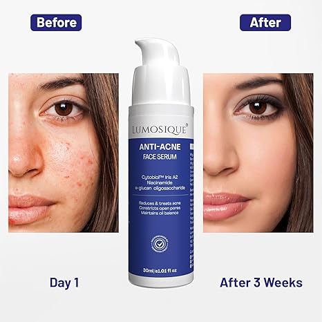 Lumosique Anti Acne Salicylic Acid Face Serum - 30 ml