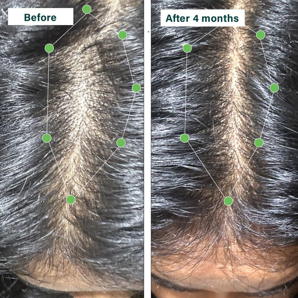 OZiva Hair Vitamin Capsules for Hair Growth & Hair Fall Control,100% Natural with Biotin, Iron, DHT Blocker & Vitamin E,Clinically Proven Hair Growth Supplements for Women & Men,60 capsules