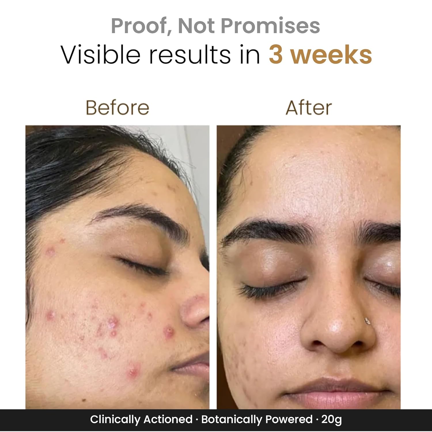 Personal Touch Zitsit Acne Spot Corrector Gel | 2% Salicylic Acid, Niacinamide & Zinc | Spot Corrector for Acne Marks, Dark Spots & Scars | Oil Control for Acne-Prone Skin | 20g
