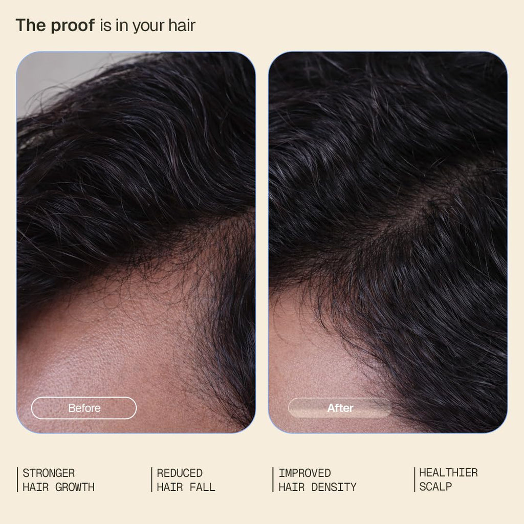 Arata Hair Growth Serum 3% Redensyl, 3% Procapil & 5% Kopexil Infused with Coffee, Onion & Rice Water | Boosts New Growth & Controls Hairfall | Hair Growth Serum for Scalp | Clinically Proven | Derma Tested | For Men & Women | 30ml