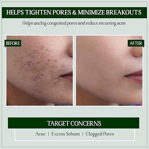 TYC Green Clay Face Mask With Niacinamide Probiotics Neem - 100 gms