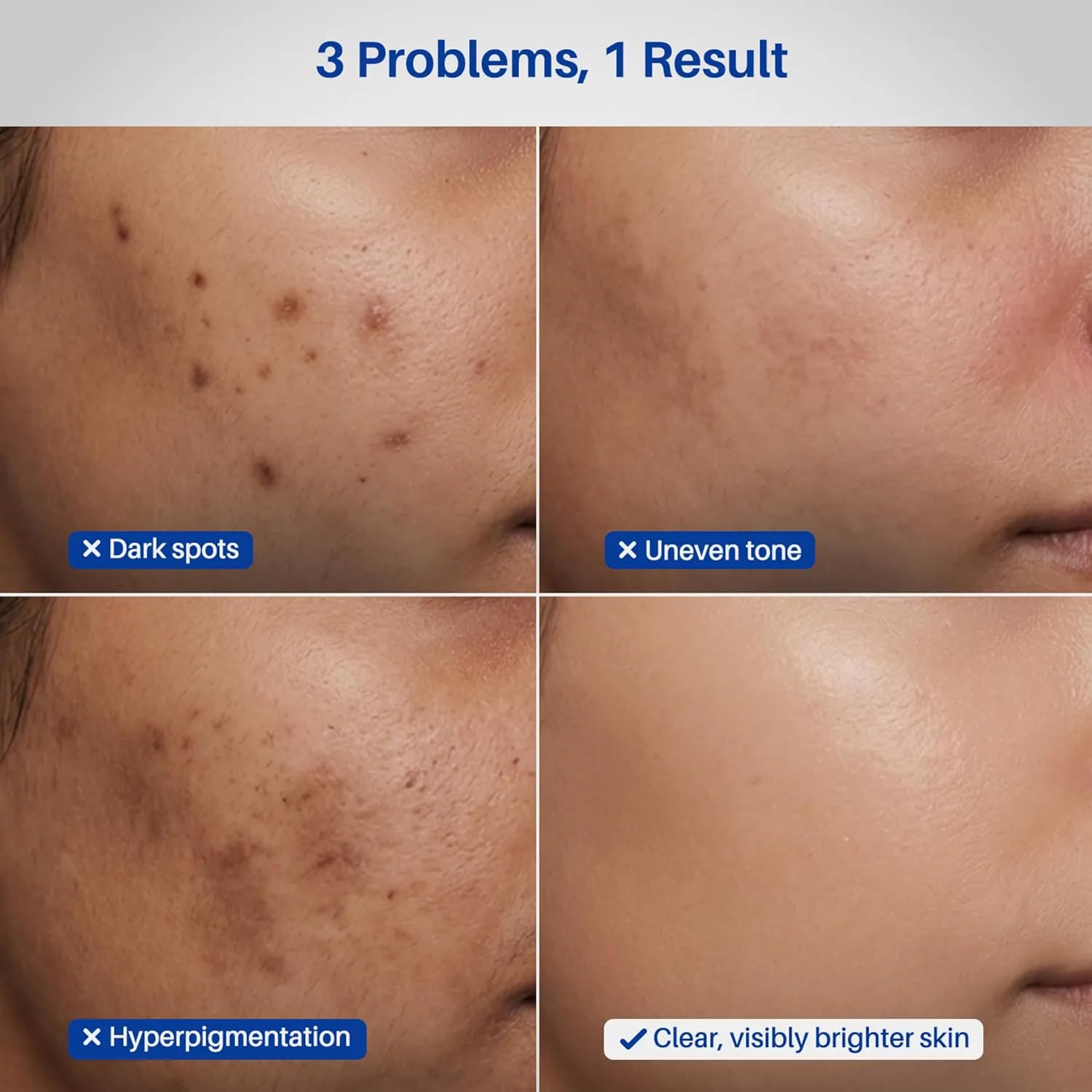 DERMDOC 2% Kojic Acid Face Serum, 20ml | Dark Spots & Pigmentation Control | Brightening, Even-Tone Formula with Niacinamide + Alpha Arbutin + Glutathione | Spot Corrector Serum for Acne Marks, Tanning & Uneven Skin Tone