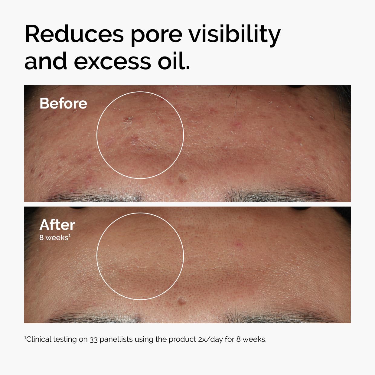 The Ordinary Niacinamide 10% + Zinc 1%, Brightening & Smoothing Serum for Blemish-Prone Skin