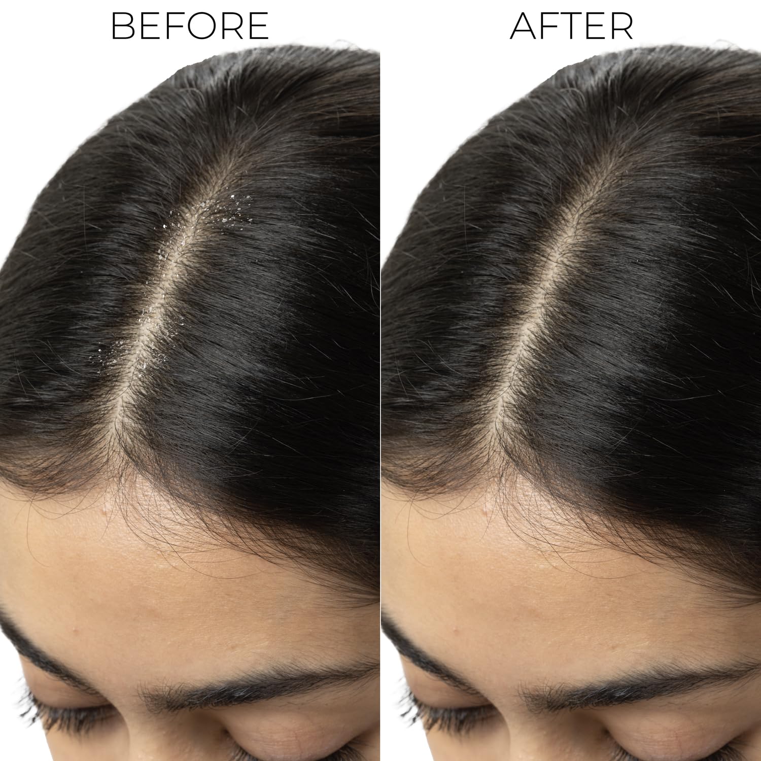 BRILLARE Professional Dandruff Control Shampoo | Anti Dandruff Shampoo for Women & Men | Shampoo for Dandruff & Itchy Scalp Relief | Reduces Flakes from 1st Wash | 300 ml