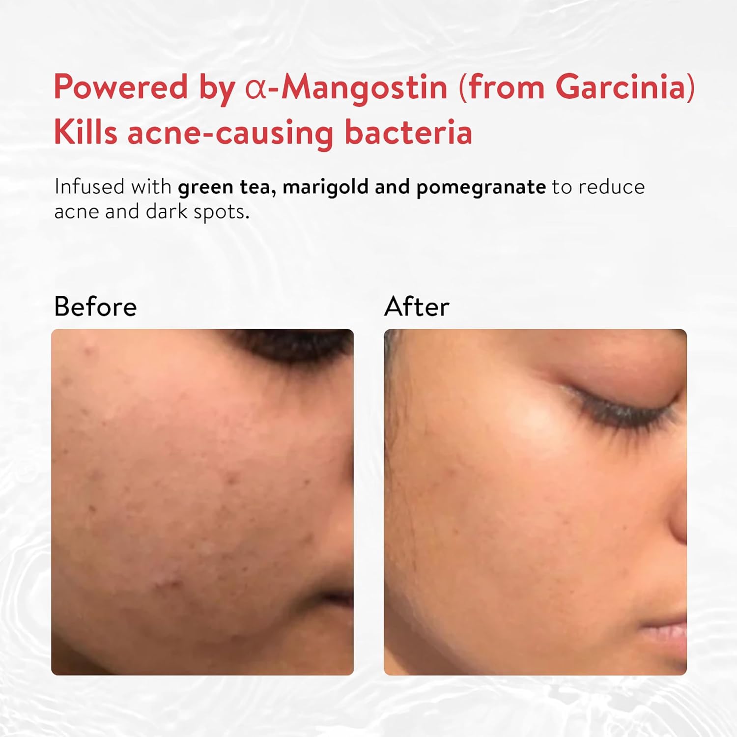 Ayouthveda Acne Enemy Face Wash Gel for Oily Skin | Acne & Pimple Control | Deep-Cleansing, Oil-Balancing & Pore-Purifying | Sulphate-Free Formula with Alpha-CURe Complex (α-Mangostin) & Garcinia | 100ml (Pack of 1)