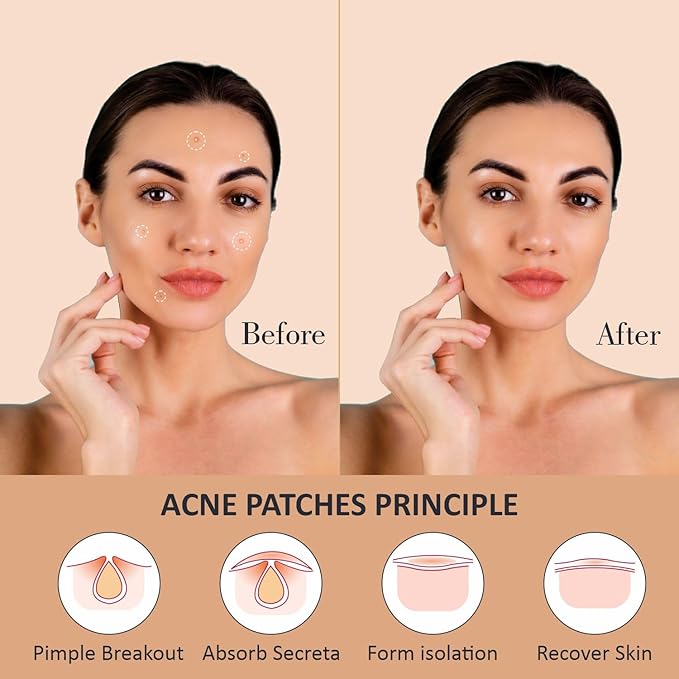 Rejusure Acne Patch | Facial Acne Patches for Pimples - 72 Patches