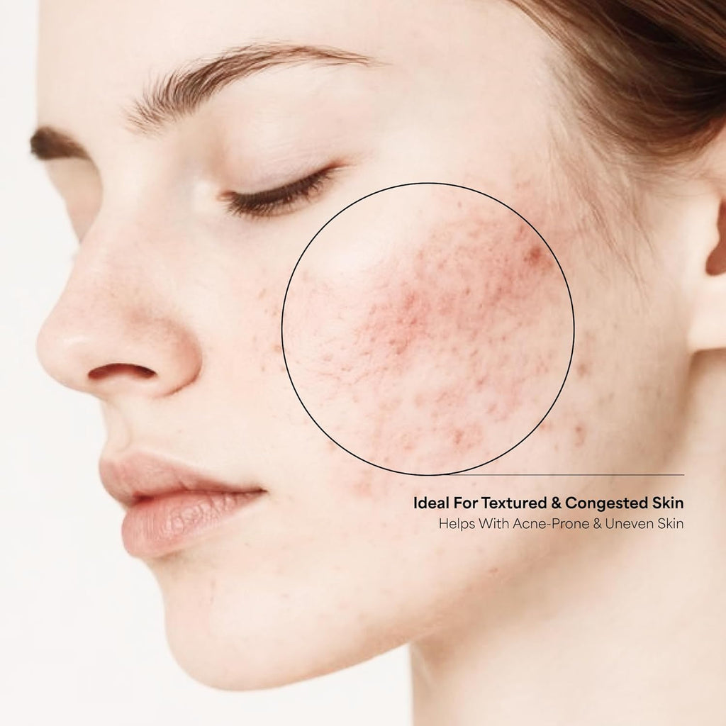 The True Therapy 30% AHA + 2% BHA + 5% PHA Skin Peeling Solution for Instant Glowing Skin â€“ 30 ml