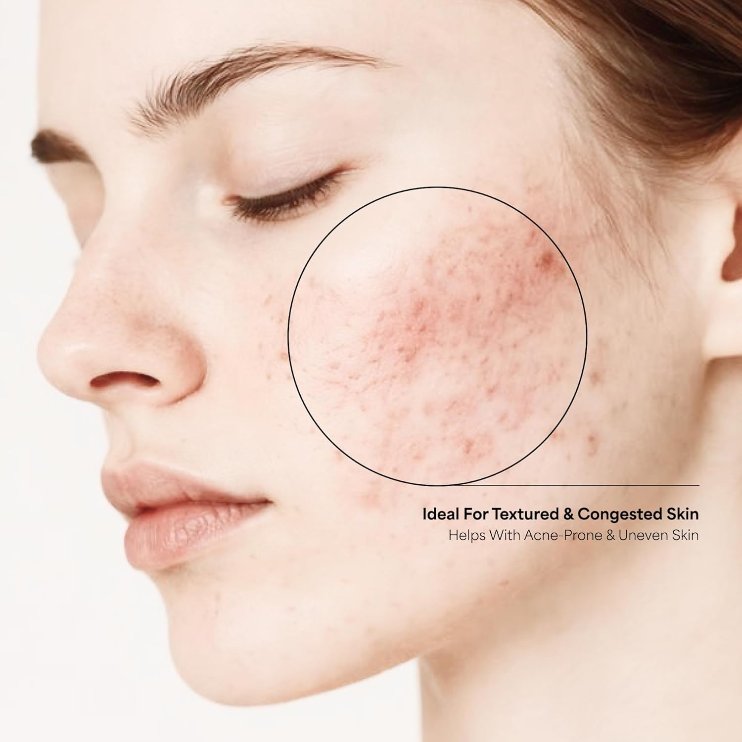 The True Therapy 30% AHA + 2% BHA + 5% PHA Skin Peeling Solution for Instant Glowing Skin â€“ 30 ml