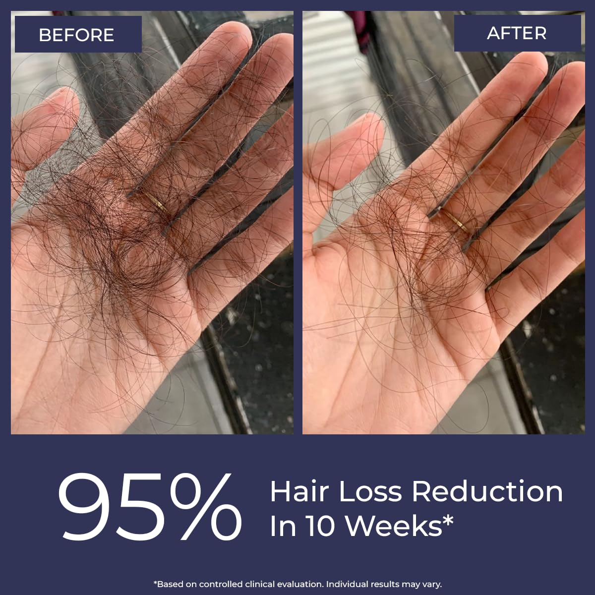 Conscious ChemistÂ® Hair Growth & Anti Hair Fall Serum | Rosemary, Redensyl, Anagain, Procapil, Biotin & Saw palmetto | Controls Hairfall & Boosts New Growth | Improves Hair Density | For Men & Women | 30ml