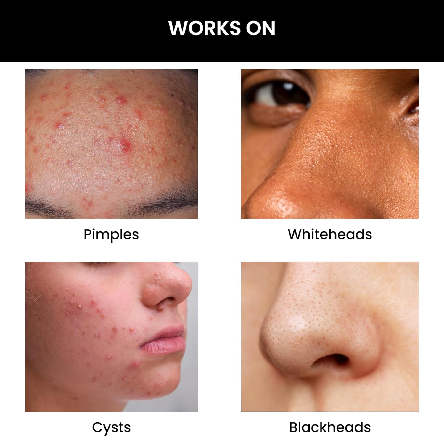 ThriveCo Goodbye Acneâ„¢ Face Wash | Reduces Acne-Causing Bacteria & Sebum Production | Men & Women (Facewash 100ml)